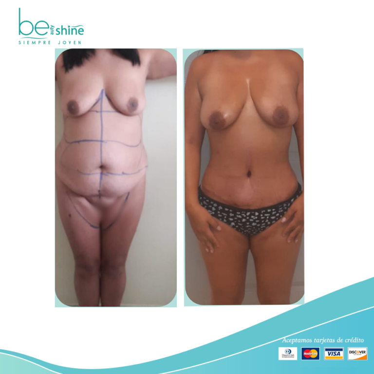 BE SHINE Abdominoplastia 4