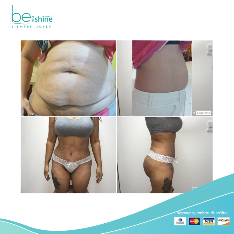 BE SHINE abdominoplastia 3